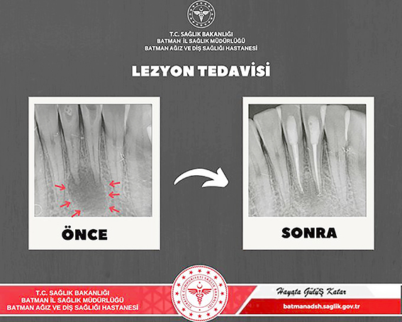 AĞIZ VE DİŞ SAĞLIĞI HASTANESİ’NDE BAŞARILI TEDAVİ
