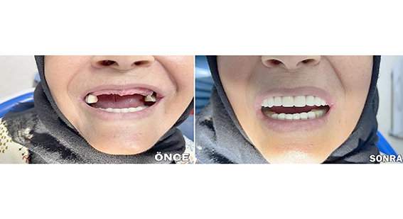 63 YAŞINDAKİ HASTAYA BAŞARILI İMPLANT TEDAVİSİ