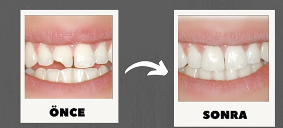 AĞIZ VE DİŞ SAĞLIĞI HASTANESİ’NDEN ESTETİK VE FONKSİYONEL ÇÖZÜM