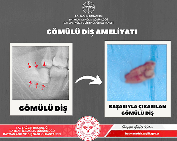 GÖMÜLÜ YİRMİ YAŞ DİŞİ BAŞARIYLA ALINDI