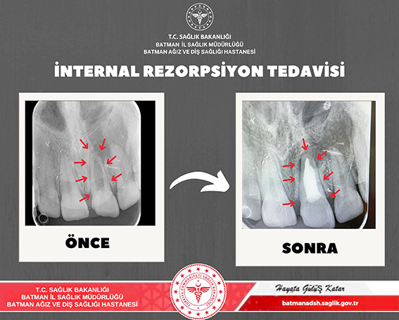 İNTERNAL REZORPSİYON TEŞHİSİ KONULAN HASTANIN DİŞİ KURTARILDI