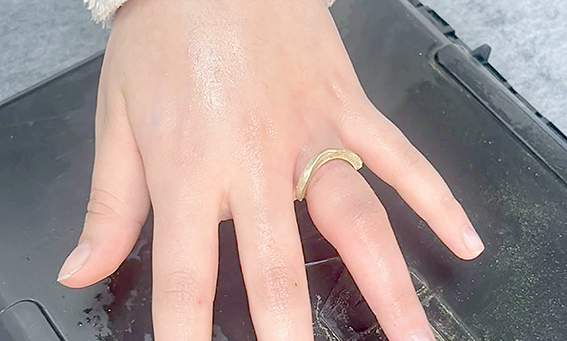 PARMAĞINA SIKIŞAN YÜZÜK EKİPLER TARAFINDAN ÇIKARILDI