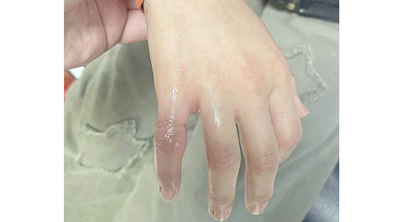 PARMAĞINA SIKIŞAN METAL PARÇA EKİPLERCE ÇIKARILDI